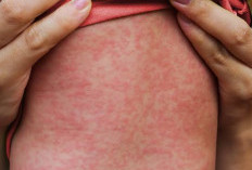 Waspadai Penyakit Campak, 17 Anak  di Sumenep Meninggal, Kenali Gejala dan Cara Mengobatinya 