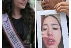 Mantan Finalis Putri Indonesia Riau Jadi Dokter Kecantikan Gadungan, Belasan Korban Alami Luka Permanen 
