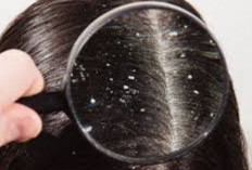 Kemiri  Bisa Atasi Ketombe Hingga Rambut Rontok, Ini Caranya 