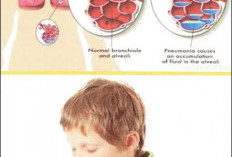 Pneumonia  Merebak, Kenali Ciri-ciri dan Gejalanya