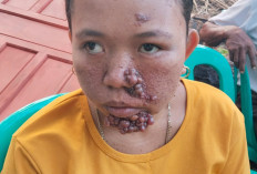  Baznas Mukomuko Bantu   Warga Pengidap Penyakit Aneh, Ini Ceritanya    